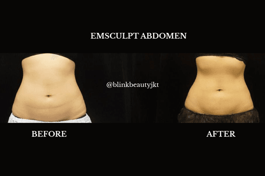 Emsculpt perut