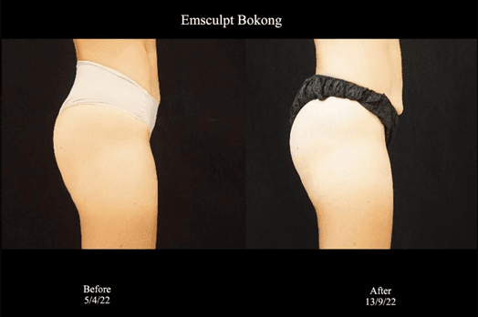 Emsculptbokong