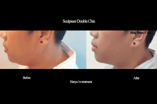 Result face doublechin 01