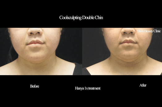 Result face doublechin 02