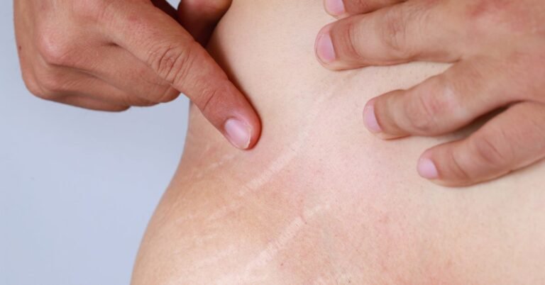 Penyebab stretch mark